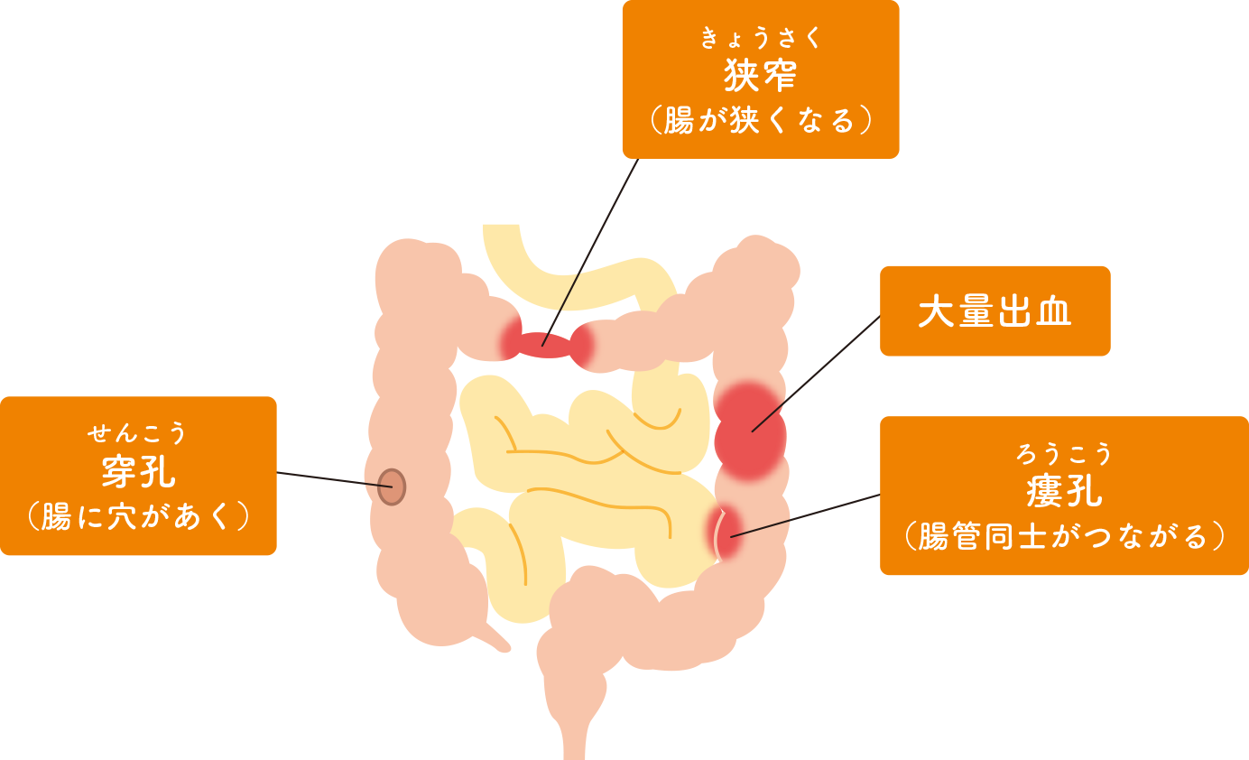 主な腸管合併症の図解